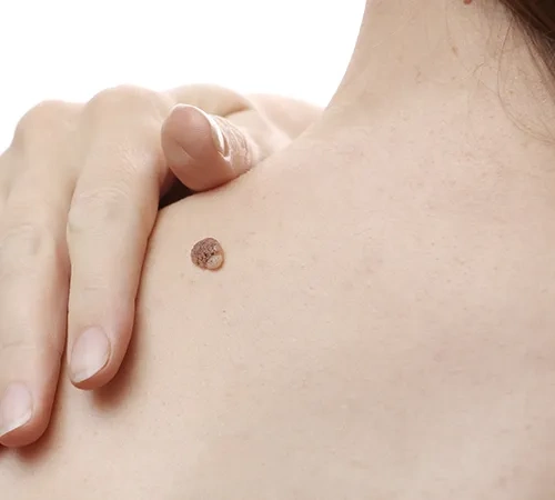 Laser Hair Removal Treatment